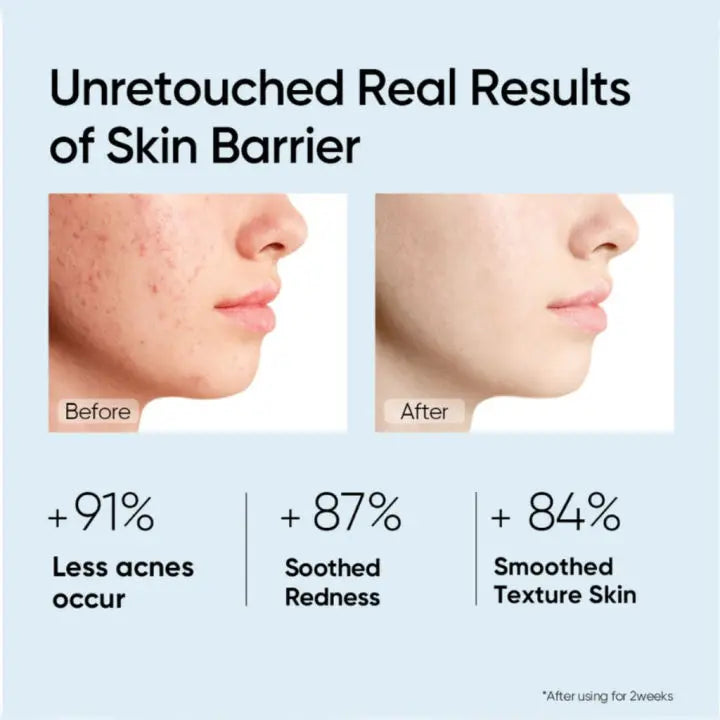 Facial Redness Repair Cream Improve Sensitive Skin Dryness Moisturizer Hydrating Sooth Lotion Removal Rosacea Korean Cosmetics